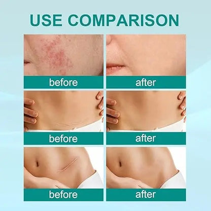 South Moon Scar Spray — سبراي ساوث مون لعلاج الندبات